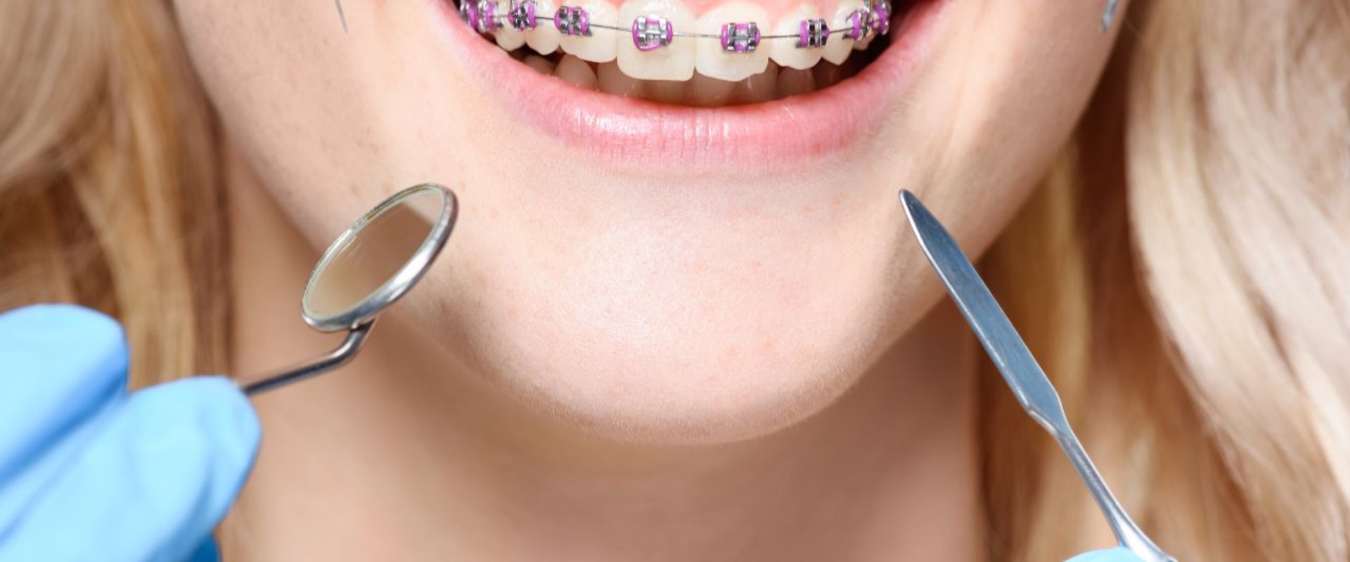 Essential Precautions to Take After Orthodontic Treatment