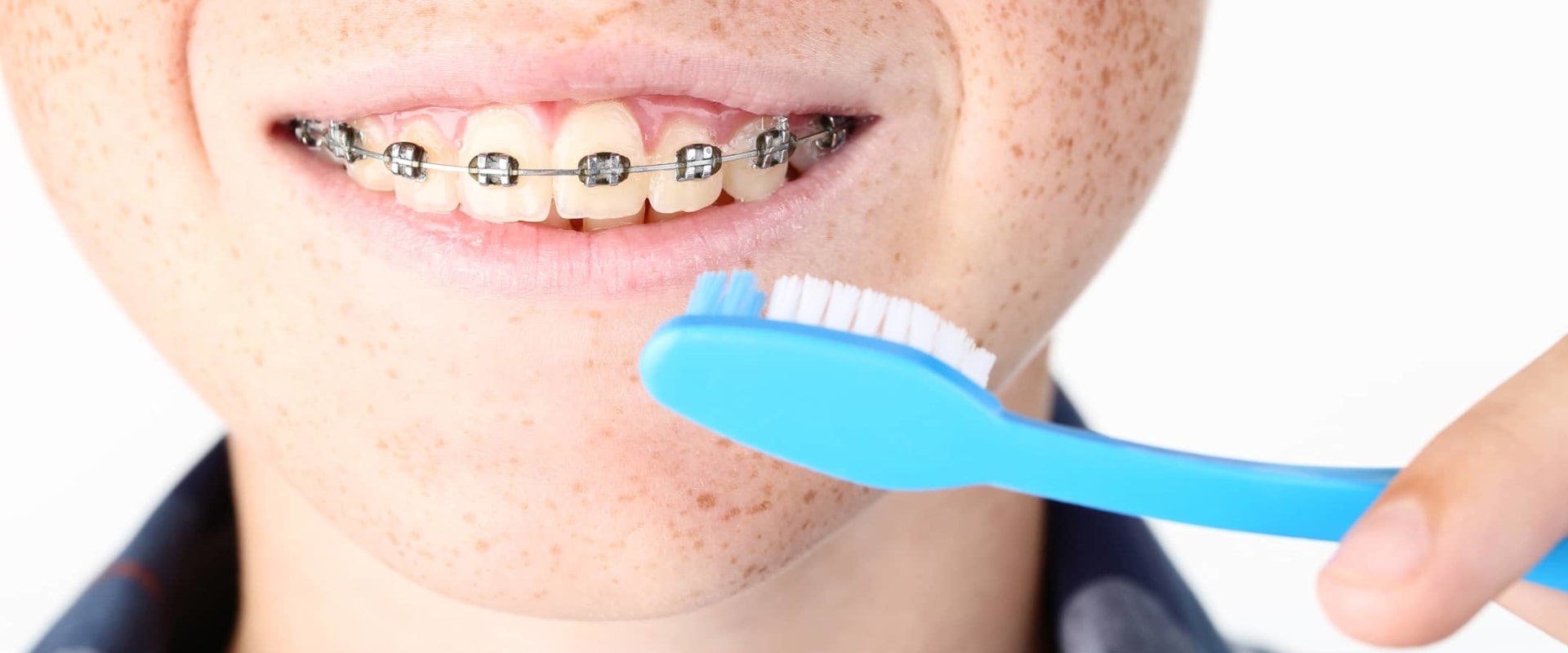 Achieving a Beautiful Smile with Proper Oral Hygiene During Orthodontic Treatment