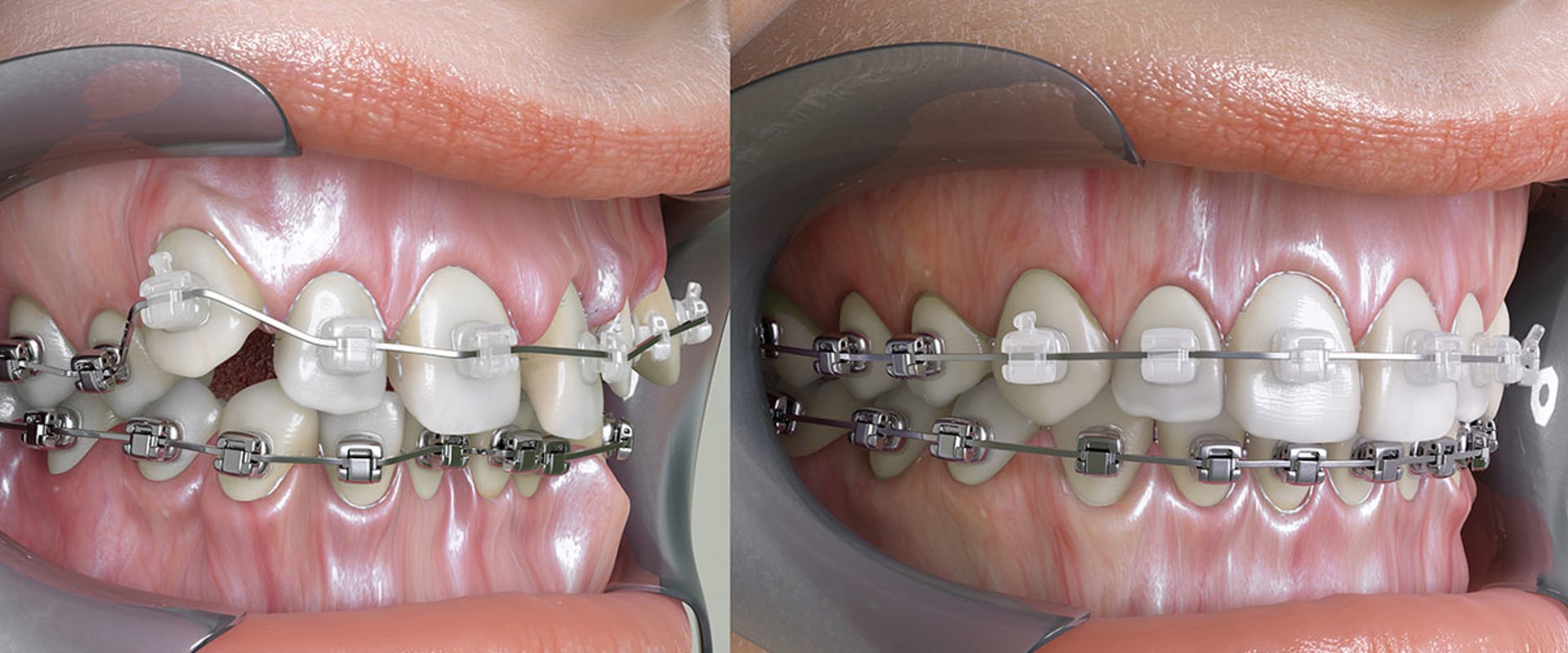 Can an Orthodontist Fix Crooked Teeth?