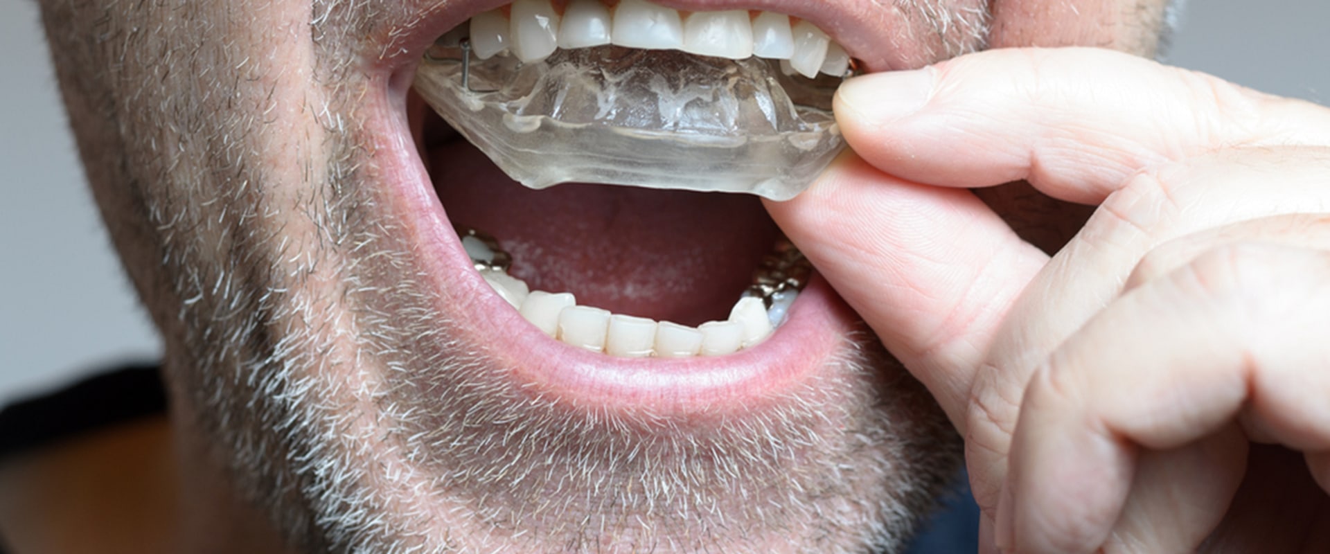 Everything You Need to Know About Orthodontic Treatment