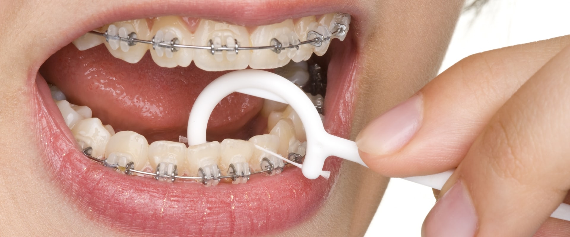 Maintaining Good Oral Hygiene with Braces: A Comprehensive Guide