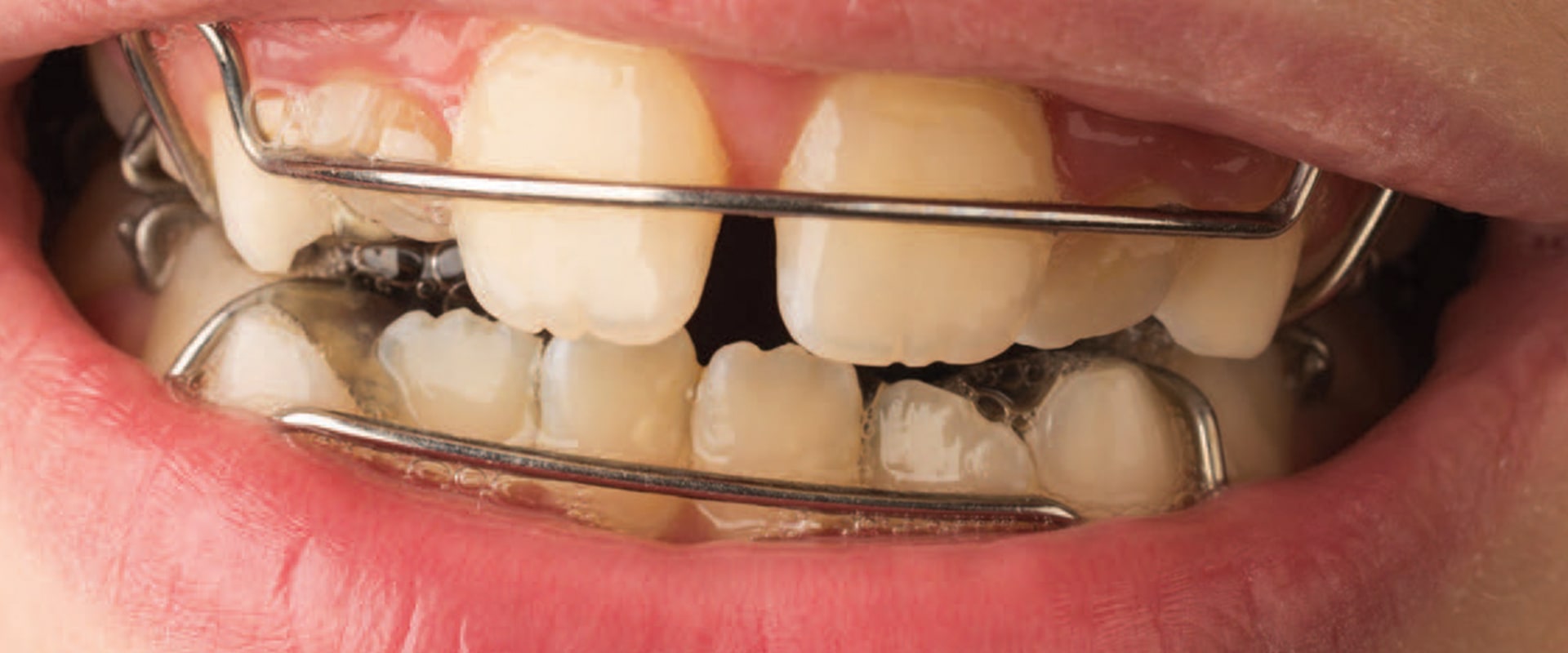 What Are the Risks of Orthodontic Treatment? A Comprehensive Guide