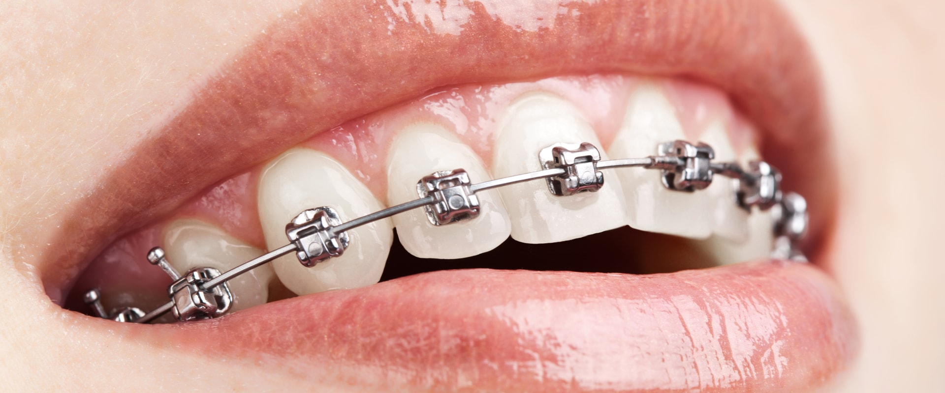 Can Braces Cause Long-Term Damage? - An Expert's Perspective