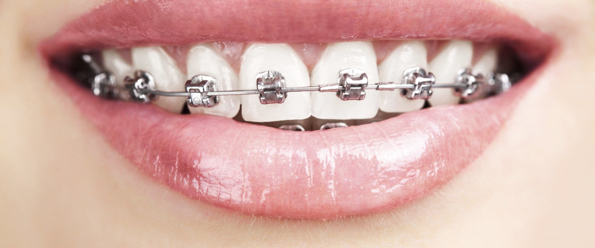 Caring for Your Teeth During Orthodontic Treatment: What You Need to Know