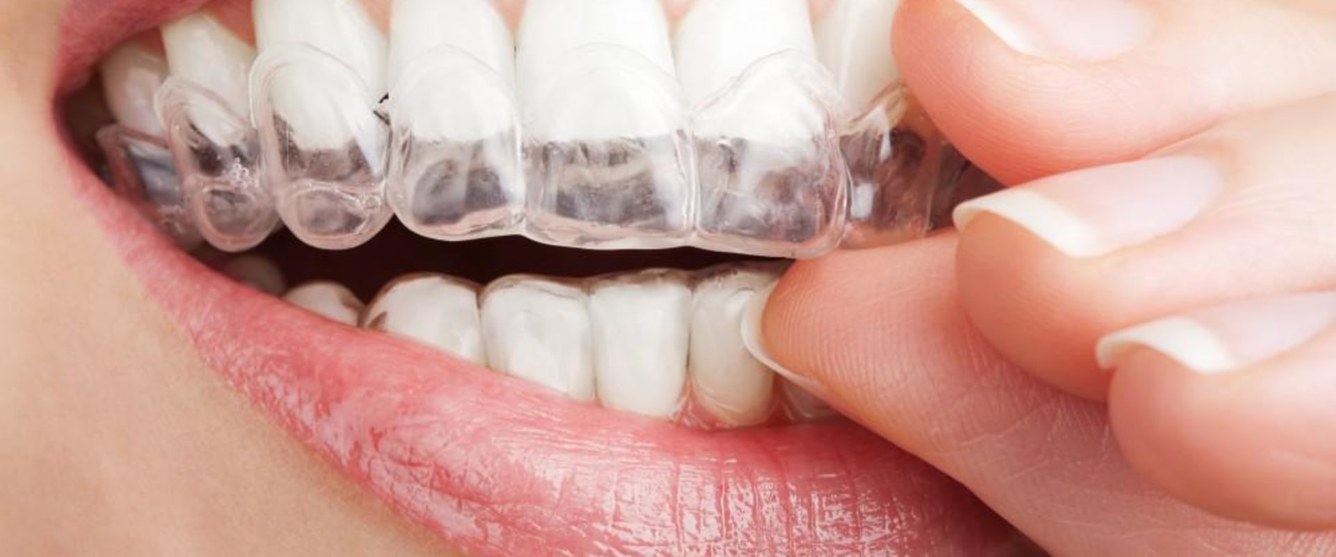 Caring for Braces and Aligners: A Comprehensive Guide