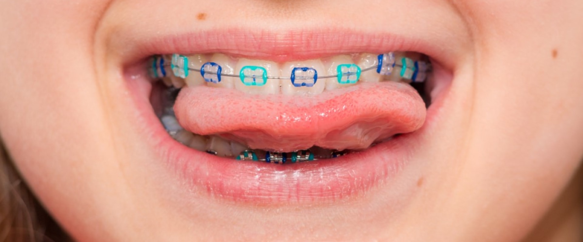 When is the Best Age for Kids to Get Orthodontic Treatment?