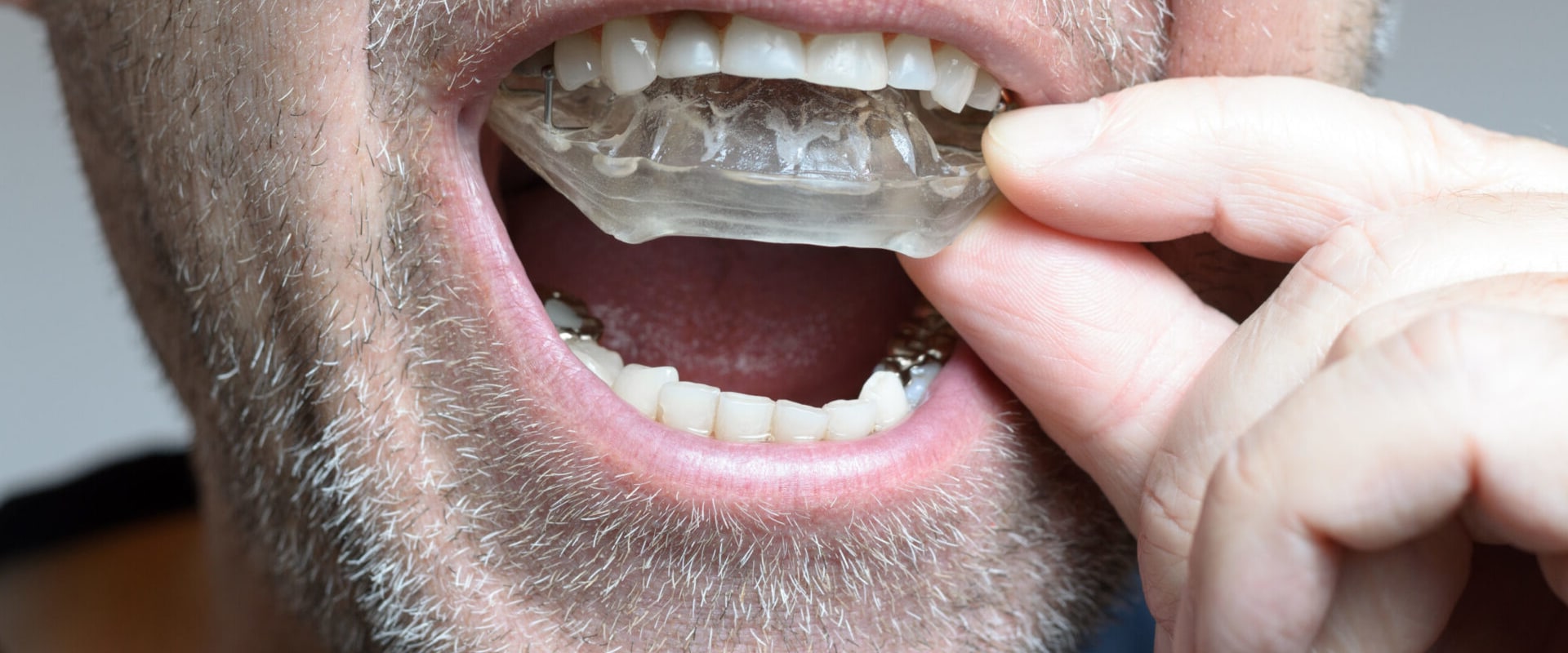 How Orthodontic Treatment Can Help Stop Tooth Grinding
