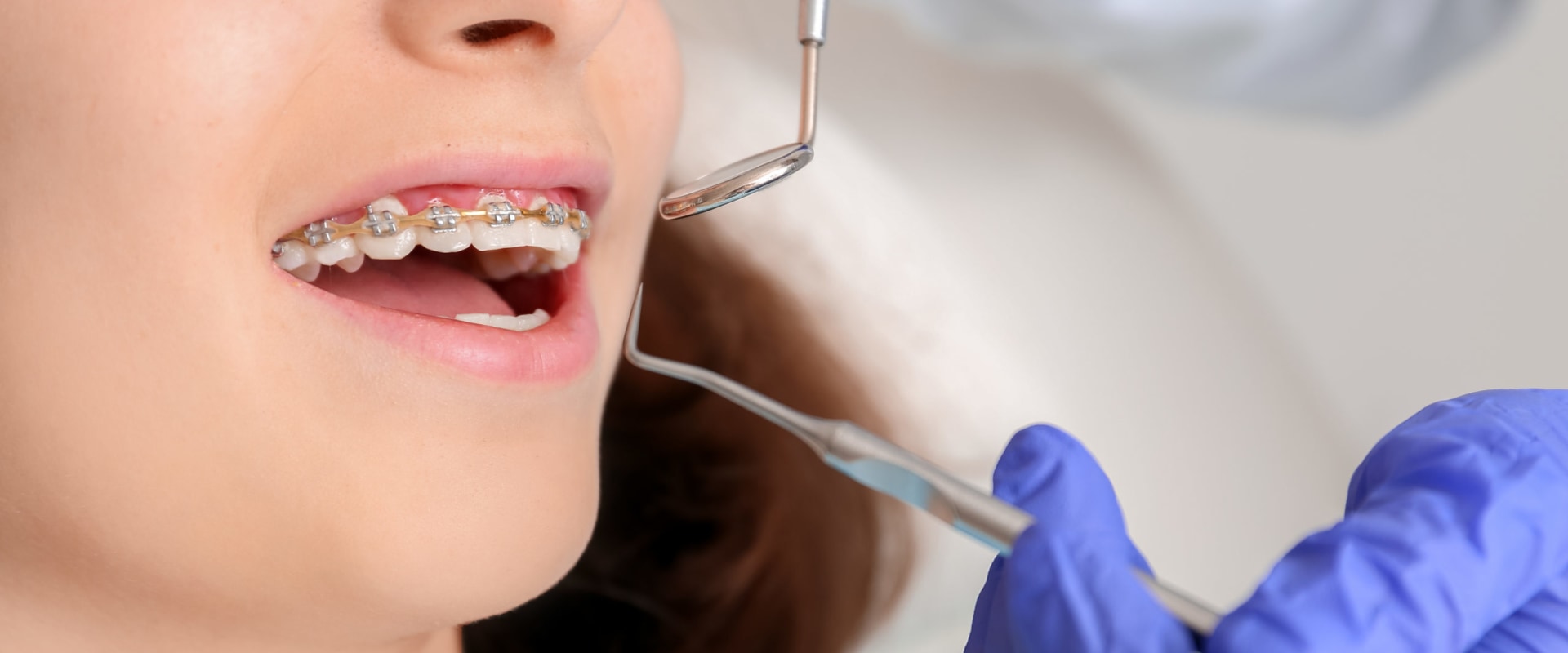 How to Avoid Cavities During Orthodontic Treatment