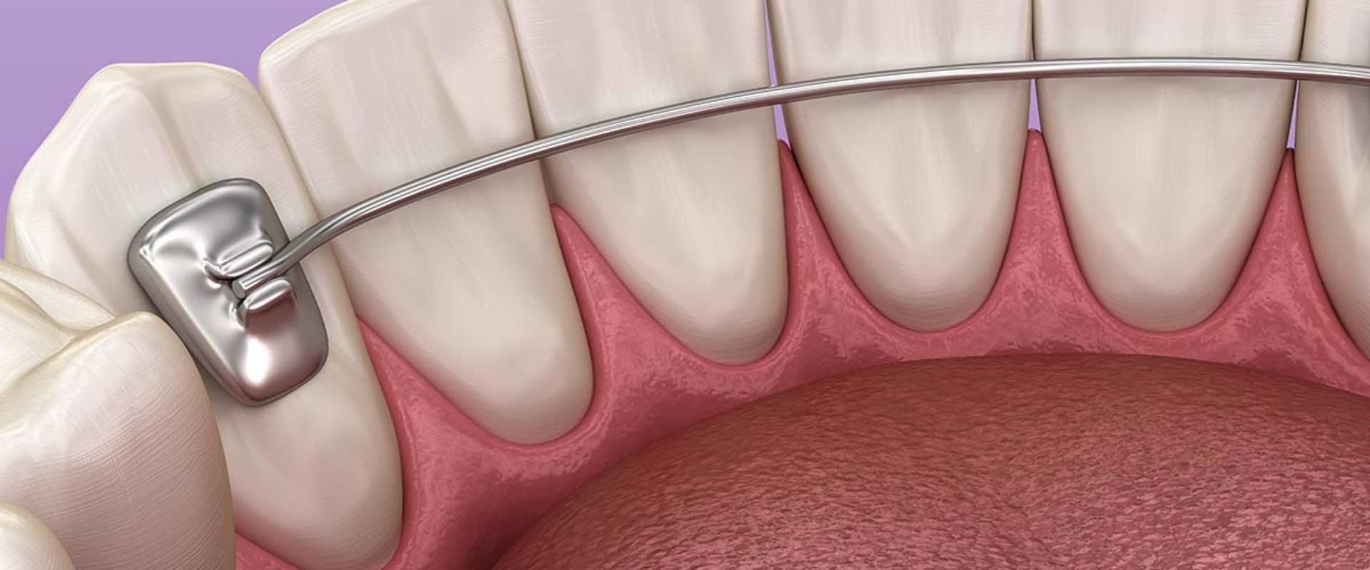 Maintaining a Perfect Smile After Orthodontic Treatment
