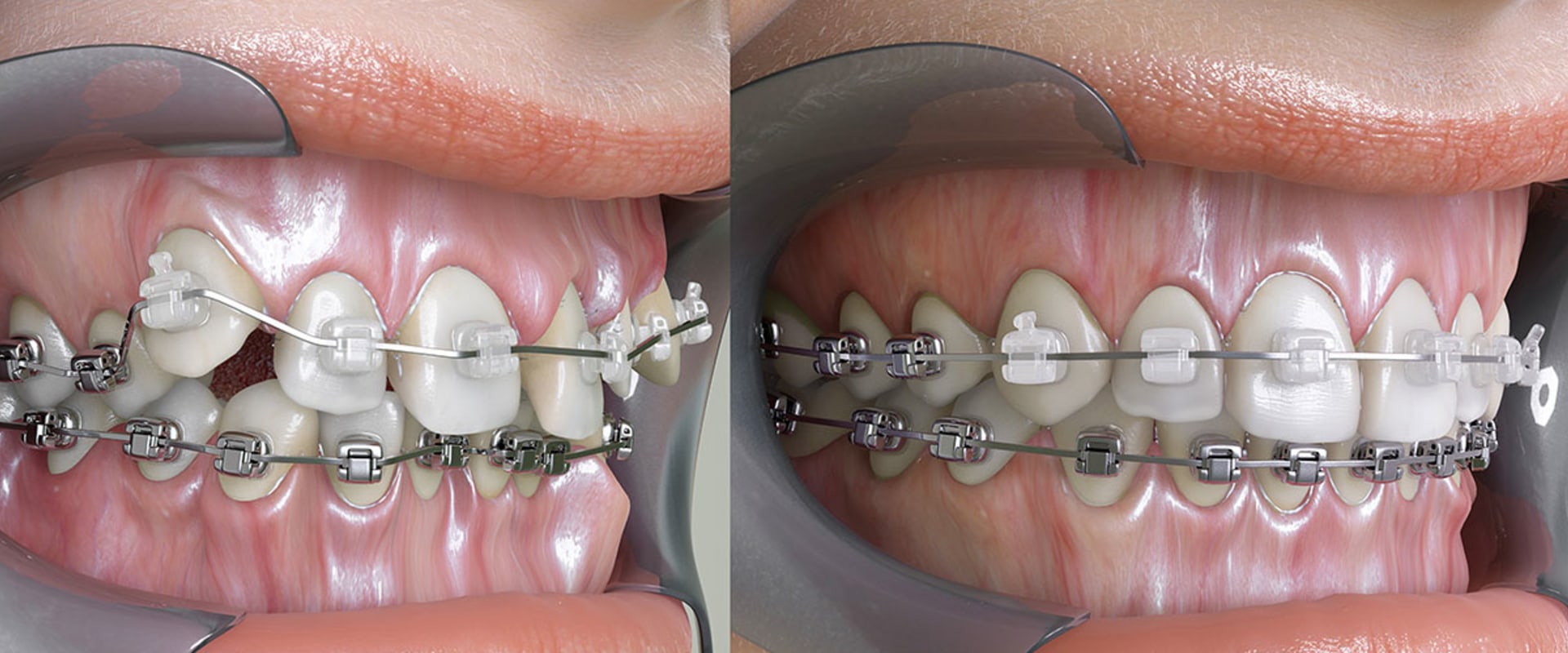 Preventing Jaw Problems During Orthodontic Treatment: Expert Advice