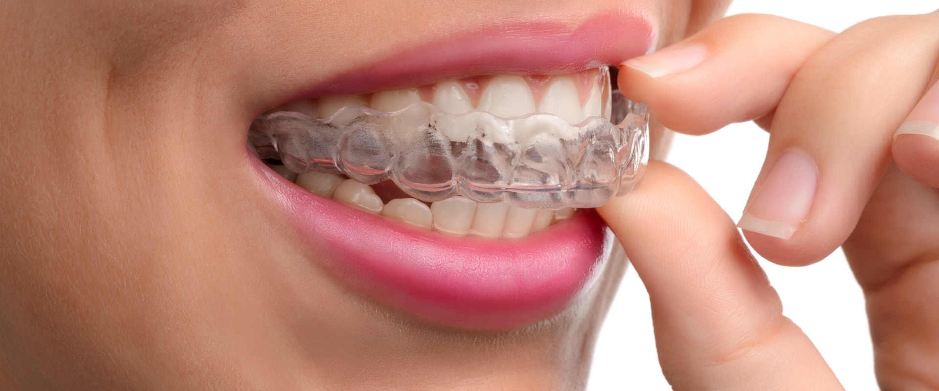 Sedation Options for Orthodontic Treatment: What You Need to Know