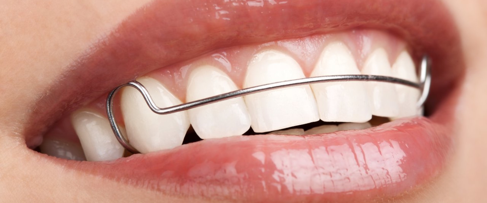 Do You Need a Retainer After Orthodontic Treatment is Complete? - An Expert's Guide