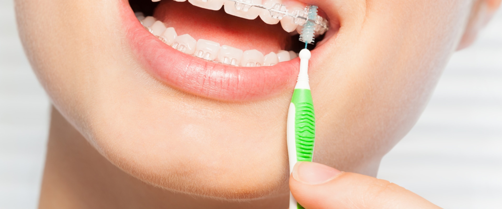 What Activities Should I Avoid During Orthodontic Treatment?
