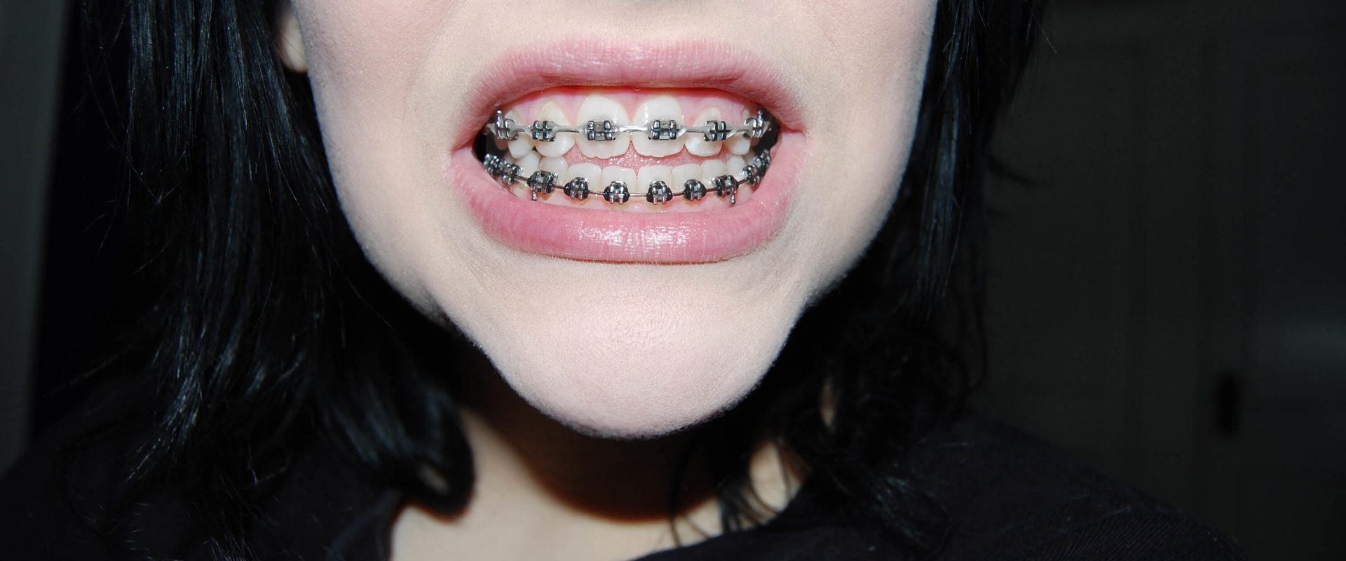 Lifestyle Changes to Make During Orthodontic Treatment: A Guide for Patients