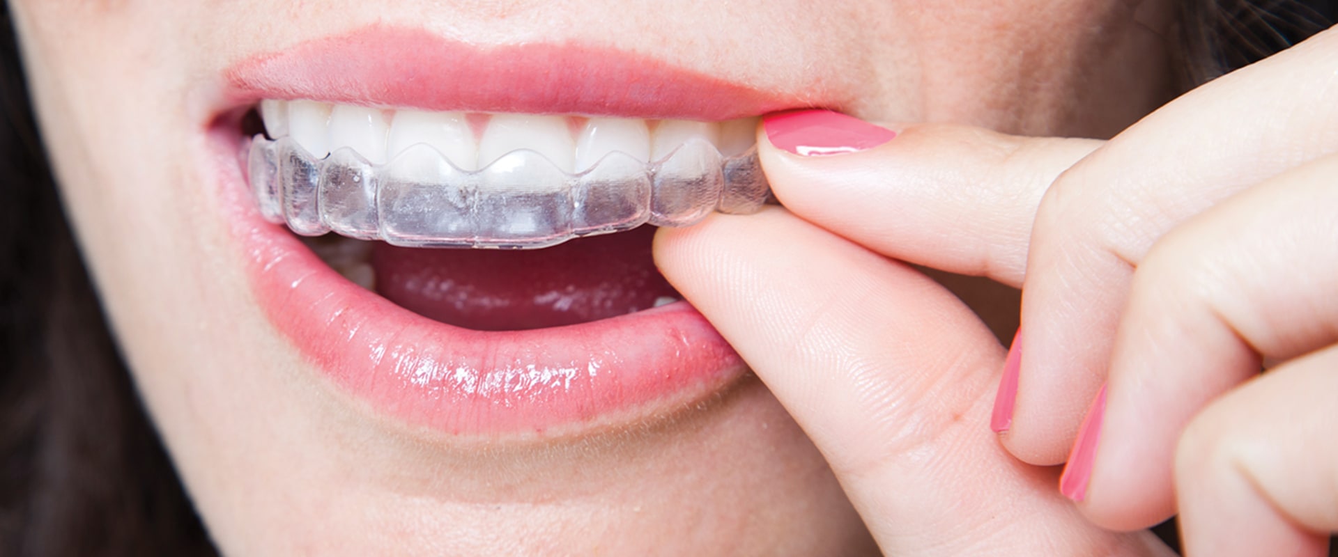 Special Techniques to Use During Orthodontic Treatment