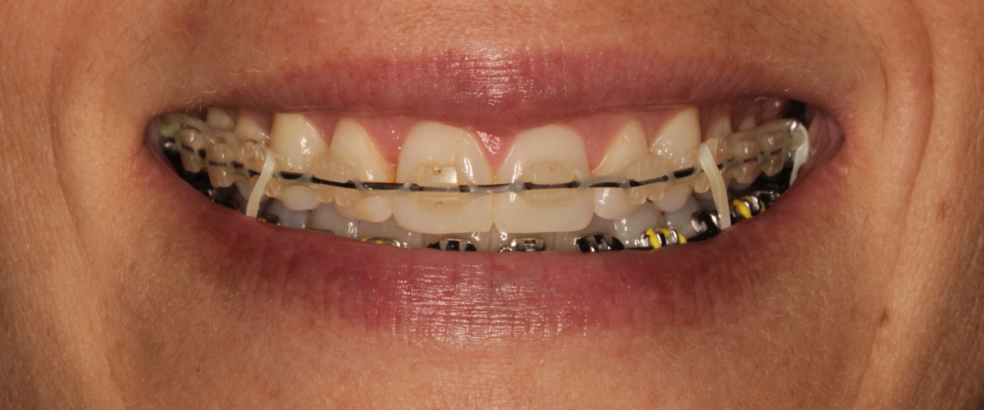 Why Do I Need Two Appointments for Braces? A Guide to Orthodontic Appointments