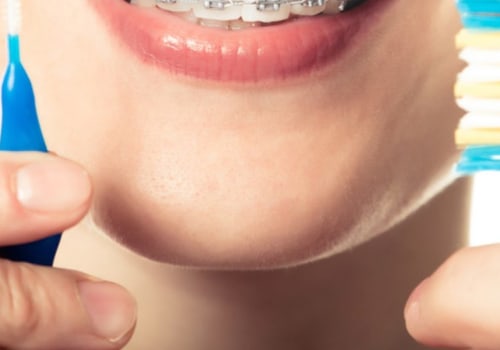 Essential Precautions to Take After Orthodontic Treatment
