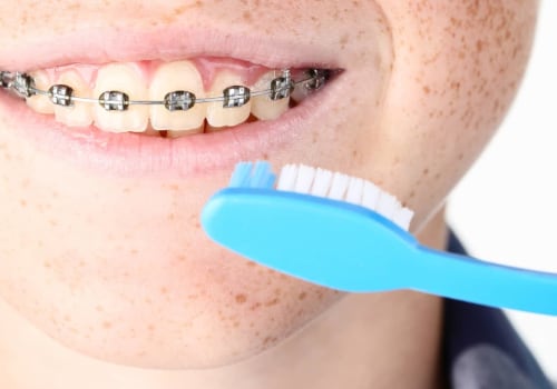 Achieving a Beautiful Smile with Proper Oral Hygiene During Orthodontic Treatment