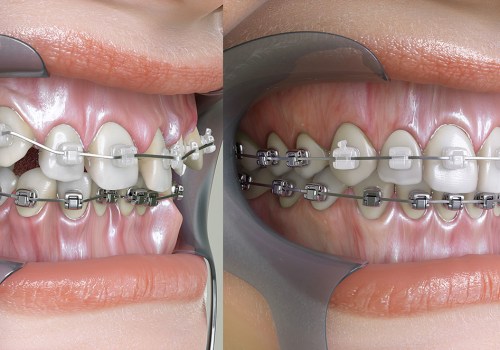 Can an Orthodontist Fix Crooked Teeth?
