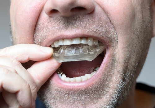 Everything You Need to Know About Orthodontic Treatment