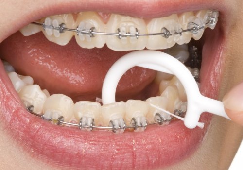 Maintaining Good Oral Hygiene with Braces: A Comprehensive Guide
