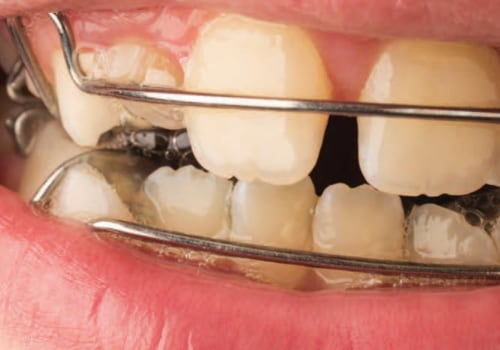 What Are the Risks of Orthodontic Treatment? A Comprehensive Guide