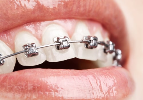 Can Braces Cause Long-Term Damage? - An Expert's Perspective
