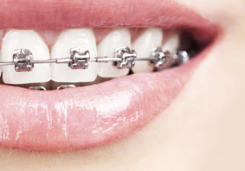 Caring for Your Teeth During Orthodontic Treatment: What You Need to Know