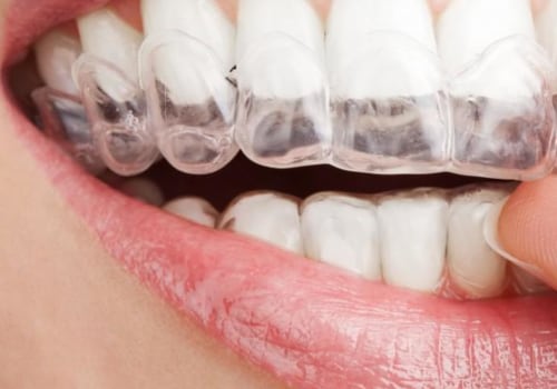 Caring for Braces and Aligners: A Comprehensive Guide