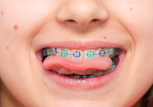 When is the Best Age for Kids to Get Orthodontic Treatment?