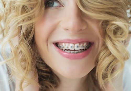 7 Tips to Make Living Easier with Braces