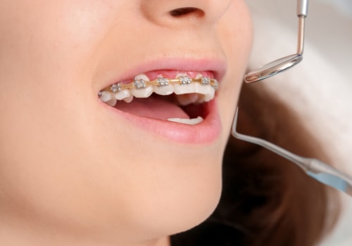 How to Avoid Cavities During Orthodontic Treatment