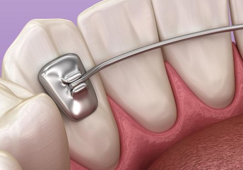 Maintaining a Perfect Smile After Orthodontic Treatment
