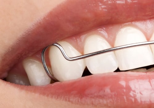 Do You Need a Retainer After Orthodontic Treatment is Complete? - An Expert's Guide