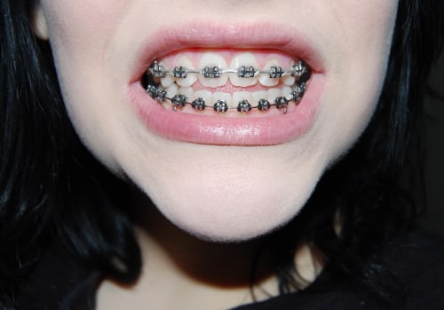 Lifestyle Changes to Make During Orthodontic Treatment: A Guide for Patients