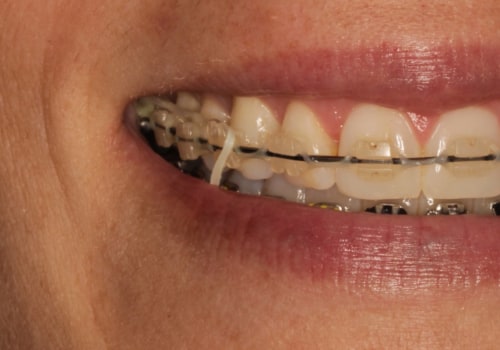 Why Do I Need Two Appointments for Braces? A Guide to Orthodontic Appointments